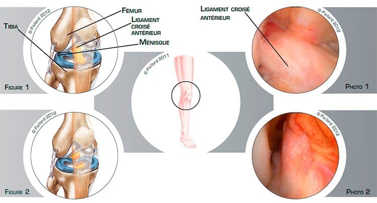 Comprendre la réathlétisation après ligamentoplastie