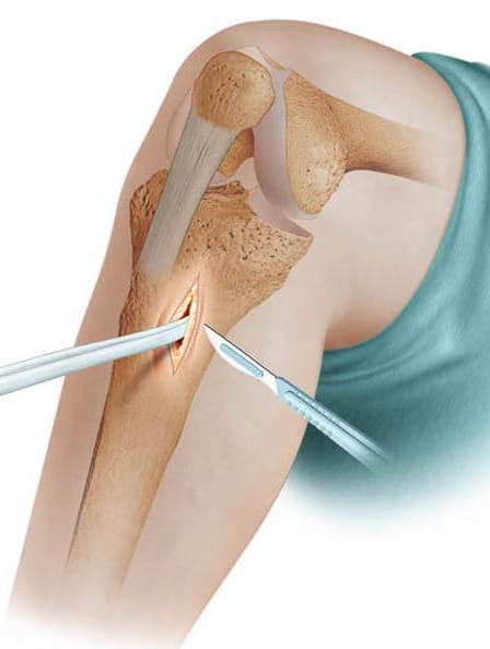 Témoignage : Mon expérience de ligamentoplastie de la cheville et ma route vers la guérison